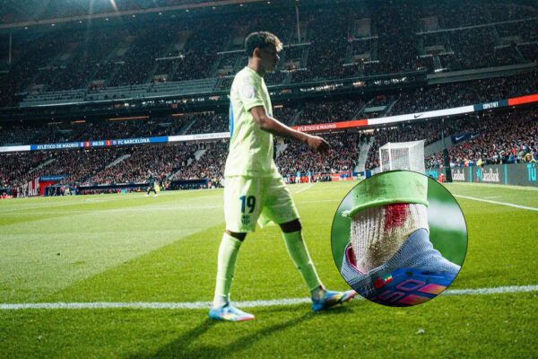 Lamine Yamal's injury casts shadow over Barcelona's Copa del Rey victory over Atletico Madrid